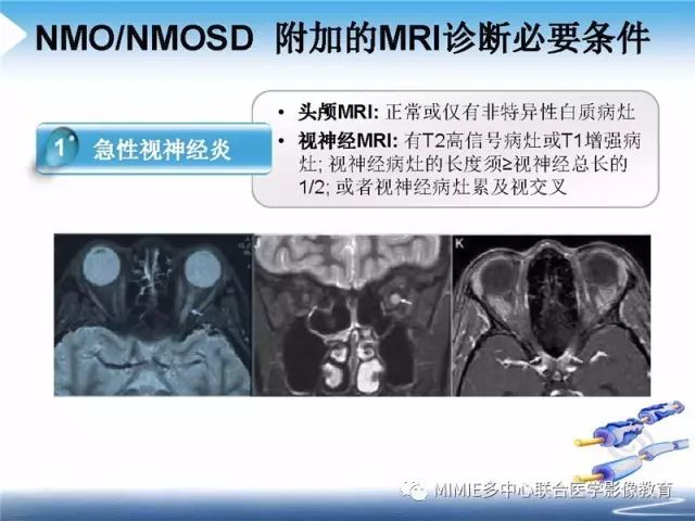 【PPT】中枢神经系统脱髓鞘疾病