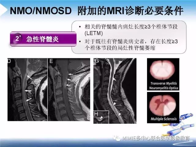 【PPT】中枢神经系统脱髓鞘疾病
