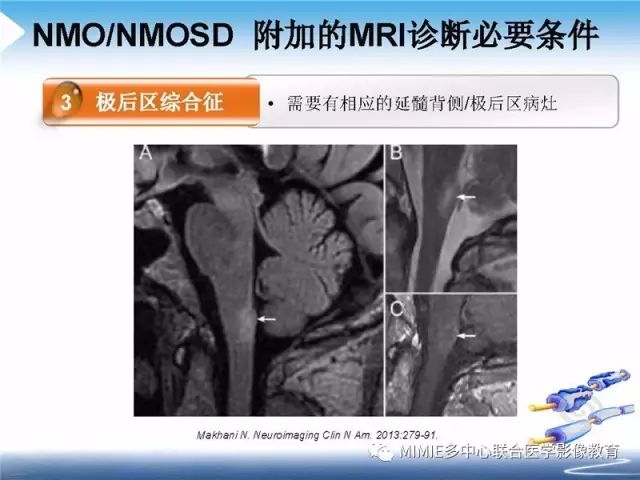 【PPT】中枢神经系统脱髓鞘疾病