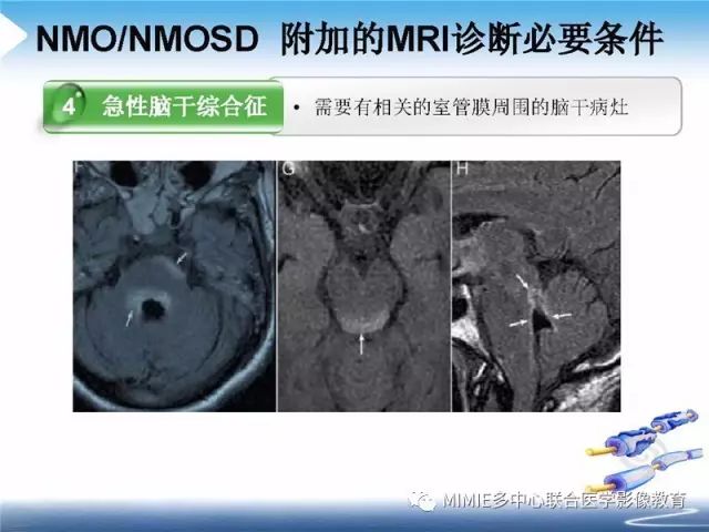 【PPT】中枢神经系统脱髓鞘疾病