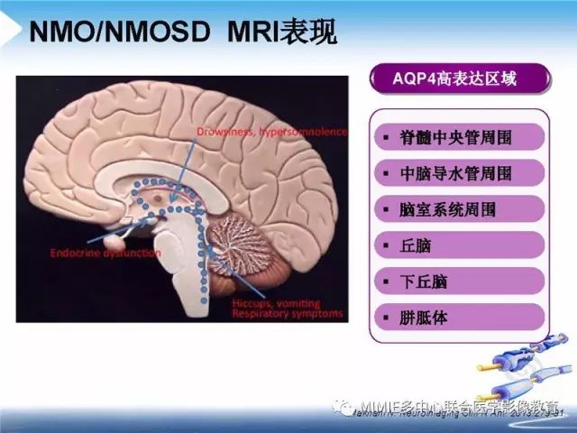 【PPT】中枢神经系统脱髓鞘疾病