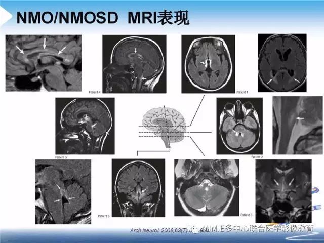 【PPT】中枢神经系统脱髓鞘疾病