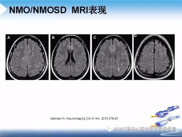 【PPT】中枢神经系统脱髓鞘疾病