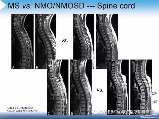 【PPT】中枢神经系统脱髓鞘疾病