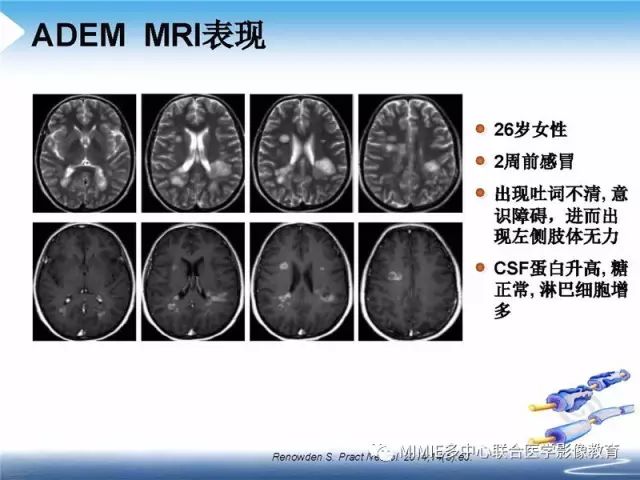 【PPT】中枢神经系统脱髓鞘疾病