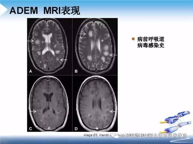【PPT】中枢神经系统脱髓鞘疾病