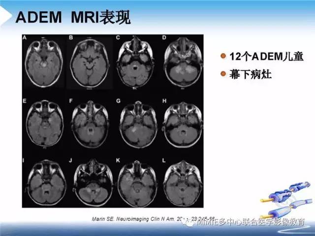 【PPT】中枢神经系统脱髓鞘疾病