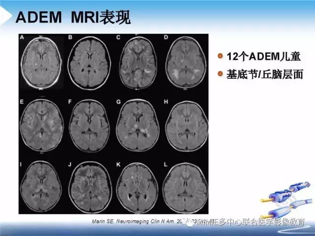 【PPT】中枢神经系统脱髓鞘疾病