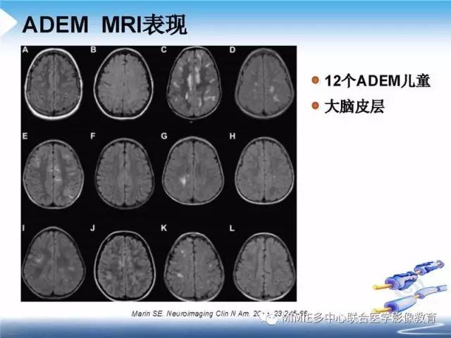 【PPT】中枢神经系统脱髓鞘疾病