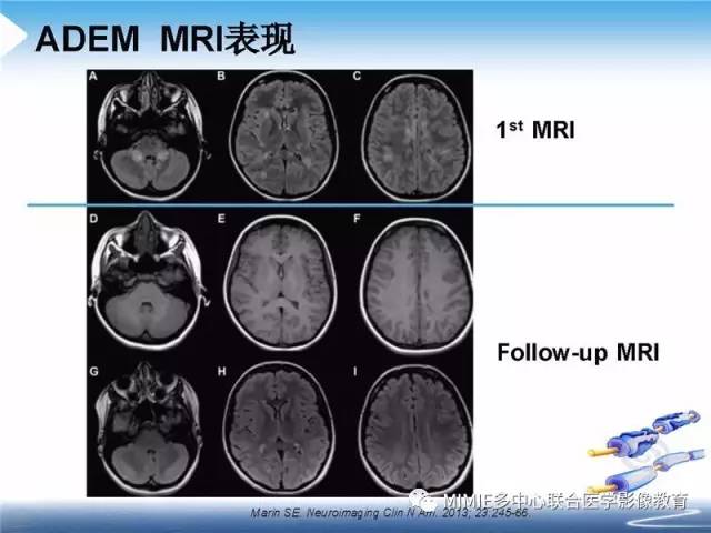 【PPT】中枢神经系统脱髓鞘疾病
