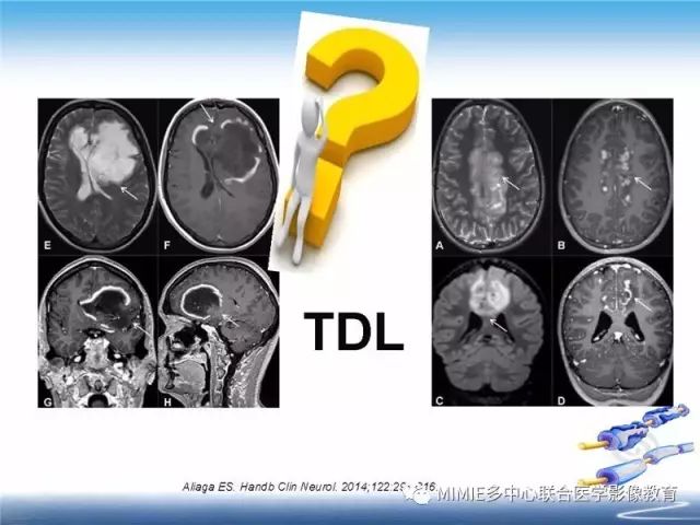 【PPT】中枢神经系统脱髓鞘疾病