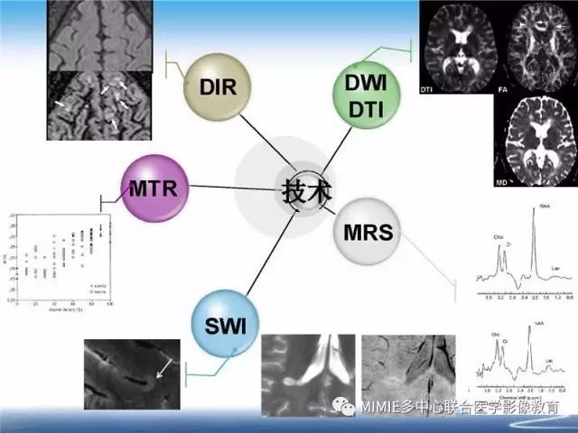 【PPT】中枢神经系统脱髓鞘疾病