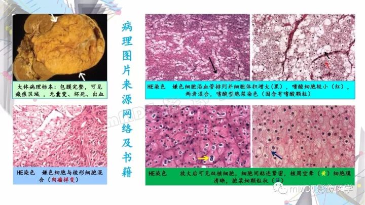 【PPT】肾嫌色细胞癌影像诊断