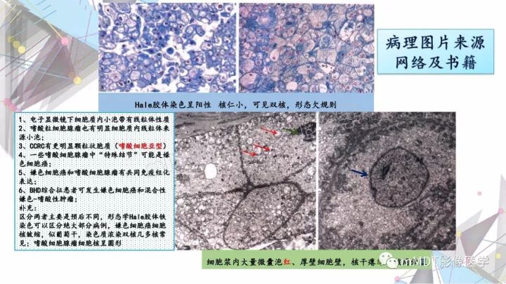 【PPT】肾嫌色细胞癌影像诊断