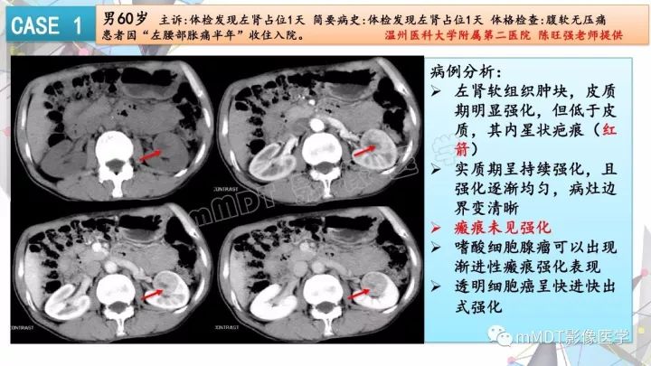 【PPT】肾嫌色细胞癌影像诊断