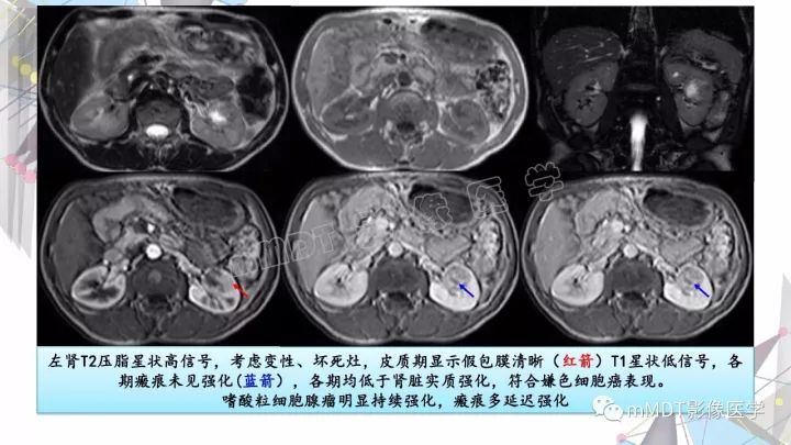 【PPT】肾嫌色细胞癌影像诊断