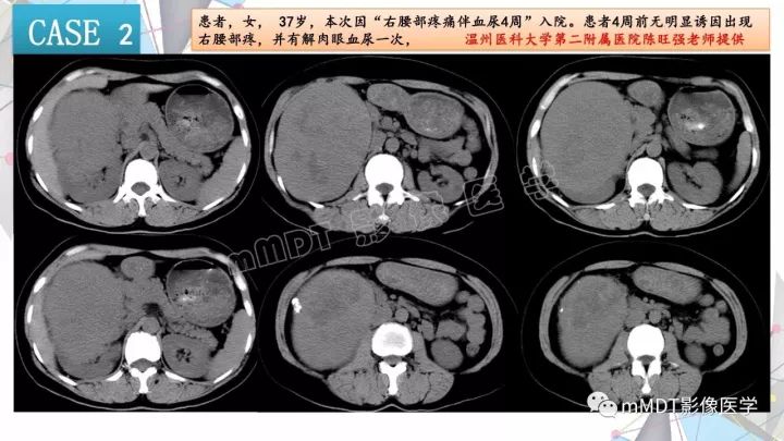 【PPT】肾嫌色细胞癌影像诊断