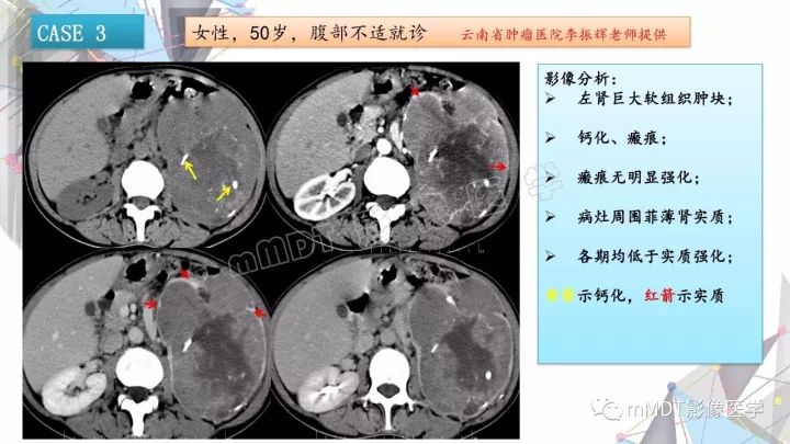 【PPT】肾嫌色细胞癌影像诊断