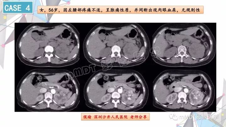 【PPT】肾嫌色细胞癌影像诊断