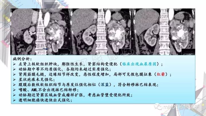 【PPT】肾嫌色细胞癌影像诊断