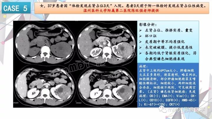 【PPT】肾嫌色细胞癌影像诊断