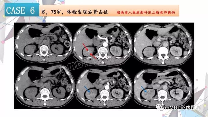【PPT】肾嫌色细胞癌影像诊断