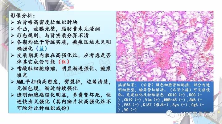 【PPT】肾嫌色细胞癌影像诊断