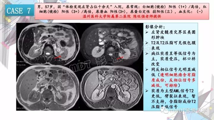 【PPT】肾嫌色细胞癌影像诊断