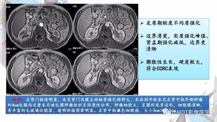 【PPT】肾嫌色细胞癌影像诊断