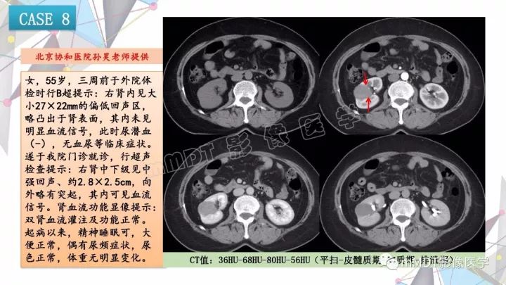 【PPT】肾嫌色细胞癌影像诊断