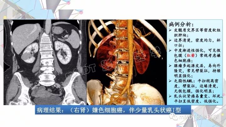 【PPT】肾嫌色细胞癌影像诊断