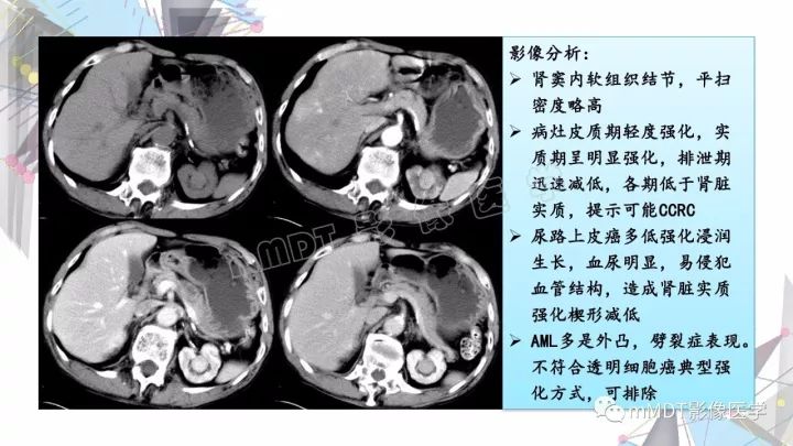 【PPT】肾嫌色细胞癌影像诊断