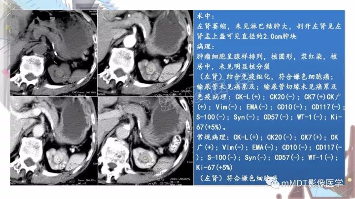 【PPT】肾嫌色细胞癌影像诊断