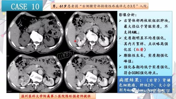 【PPT】肾嫌色细胞癌影像诊断