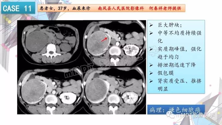 【PPT】肾嫌色细胞癌影像诊断