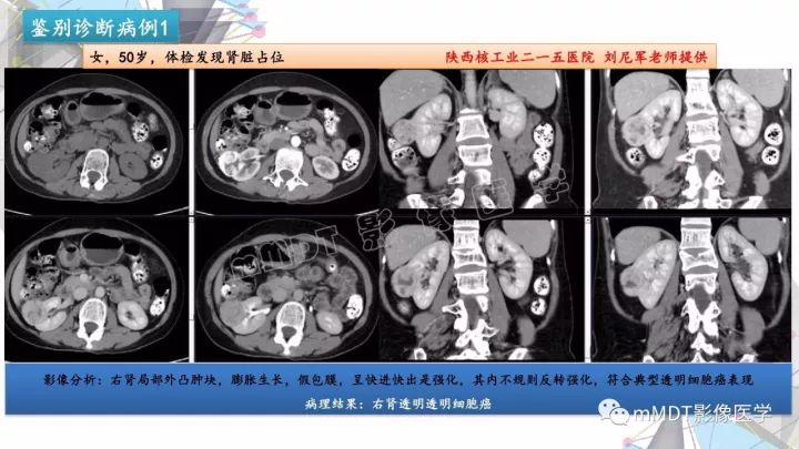 【PPT】肾嫌色细胞癌影像诊断