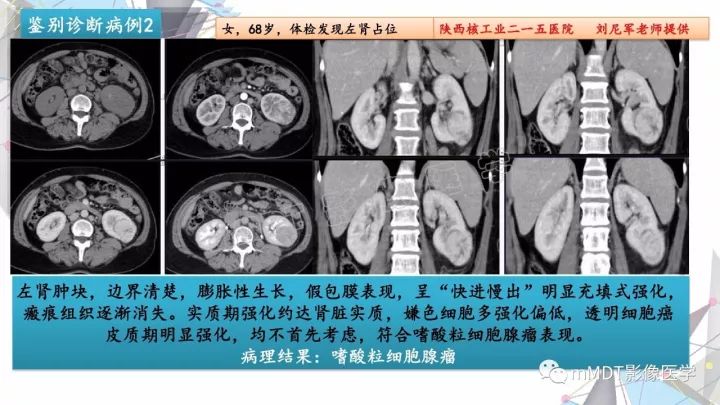 【PPT】肾嫌色细胞癌影像诊断