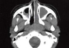【病例】鼻腔息肉伴慢性鼻窦炎1例CT