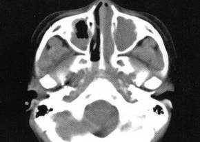 【病例】鼻腔息肉伴慢性鼻窦炎1例CT 【病例】鼻腔息肉伴慢性鼻窦炎1例CT
