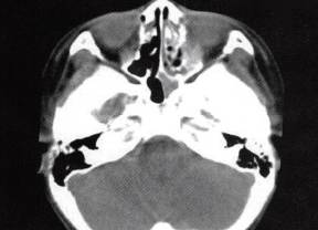 【病例】鼻腔息肉伴慢性鼻窦炎1例CT 【病例】鼻腔息肉伴慢性鼻窦炎1例CT