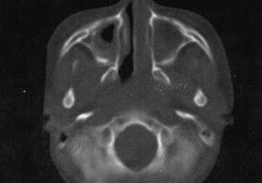 【病例】鼻腔息肉伴慢性鼻窦炎1例CT 【病例】鼻腔息肉伴慢性鼻窦炎1例CT
