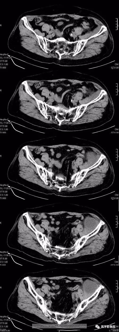【病例】左侧腹股沟区粘液脂肪肉瘤1例CT