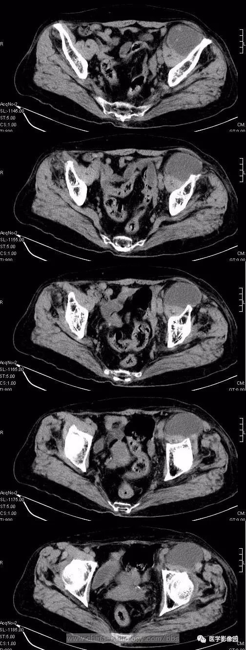 【病例】左侧腹股沟区粘液脂肪肉瘤1例CT