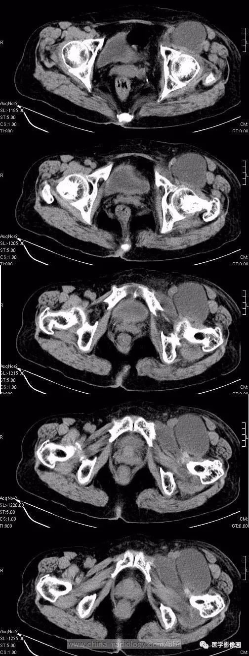 【病例】左侧腹股沟区粘液脂肪肉瘤1例CT
