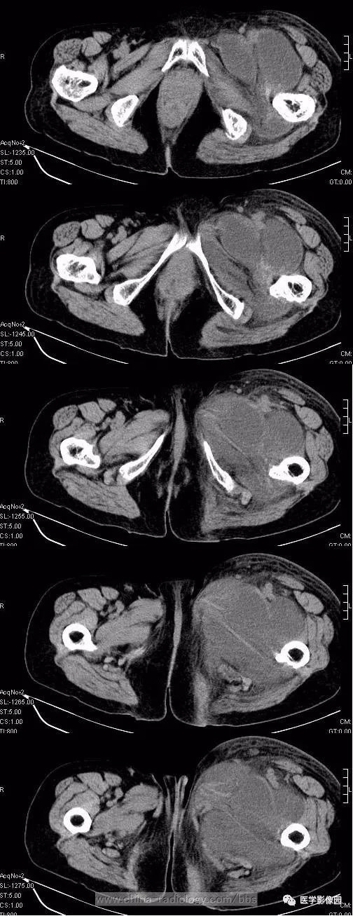 【病例】左侧腹股沟区粘液脂肪肉瘤1例CT