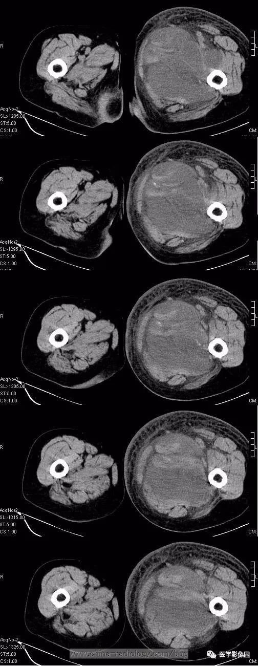【病例】左侧腹股沟区粘液脂肪肉瘤1例CT