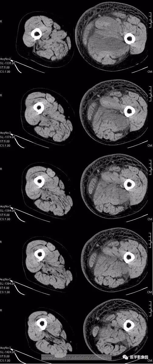 【病例】左侧腹股沟区粘液脂肪肉瘤1例CT