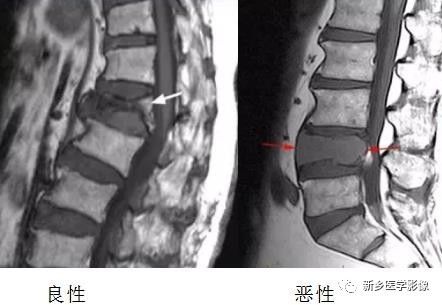 11种方法告诉您是压缩骨折还是转移 11种方法告诉您是压缩骨折还是转移