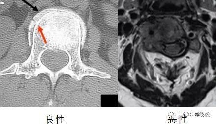 11种方法告诉您是压缩骨折还是转移 11种方法告诉您是压缩骨折还是转移