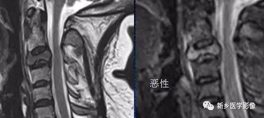 11种方法告诉您是压缩骨折还是转移